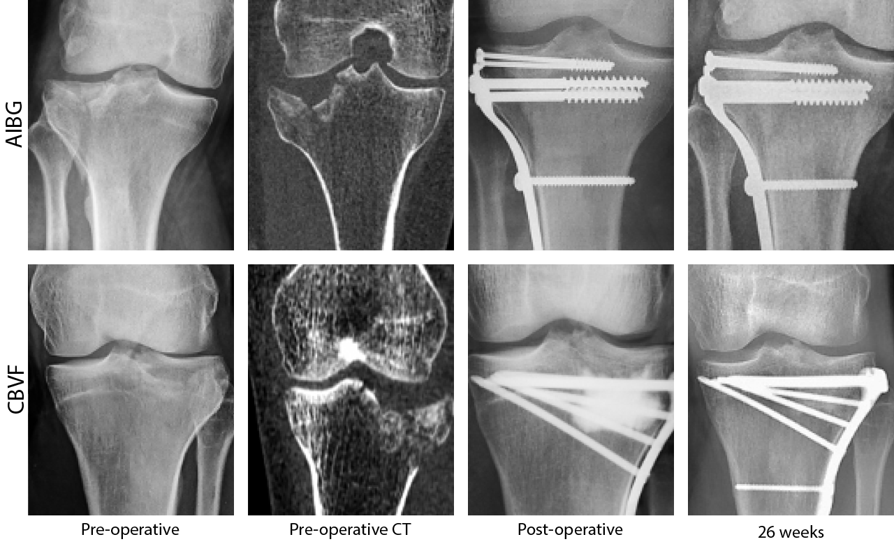 Bone Remodeling: Ex-Rays of Pre and Post-Operative Bone Healing